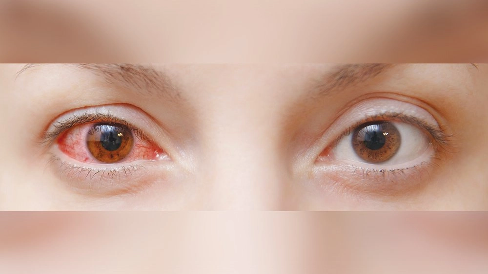 Conjectivitis.jpg