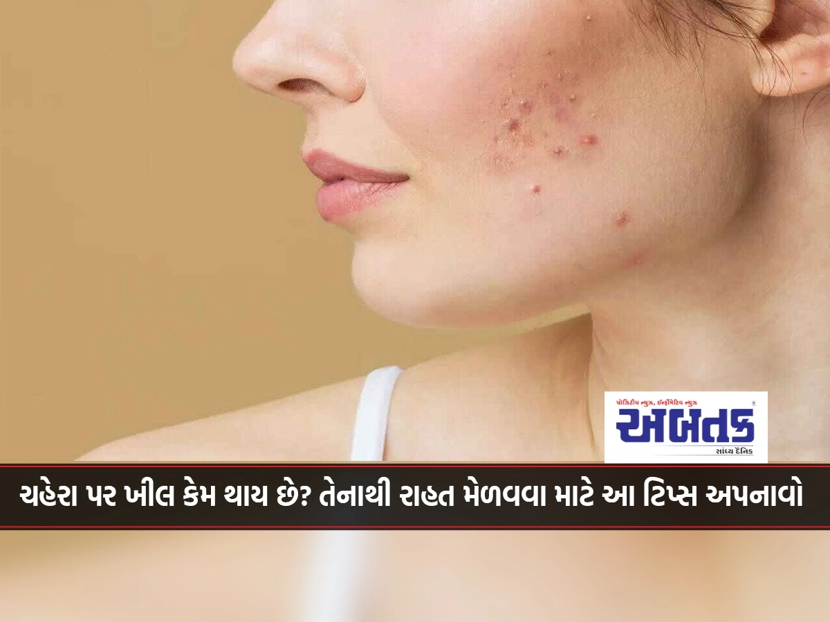 Why does acne occur on the face? Follow these tips to get relief from it