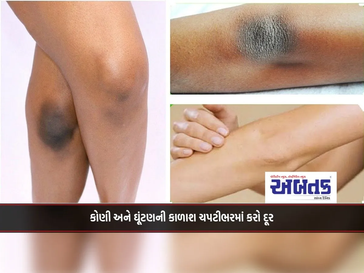 Remove Blackheads From Elbows And Knees In A Pinch