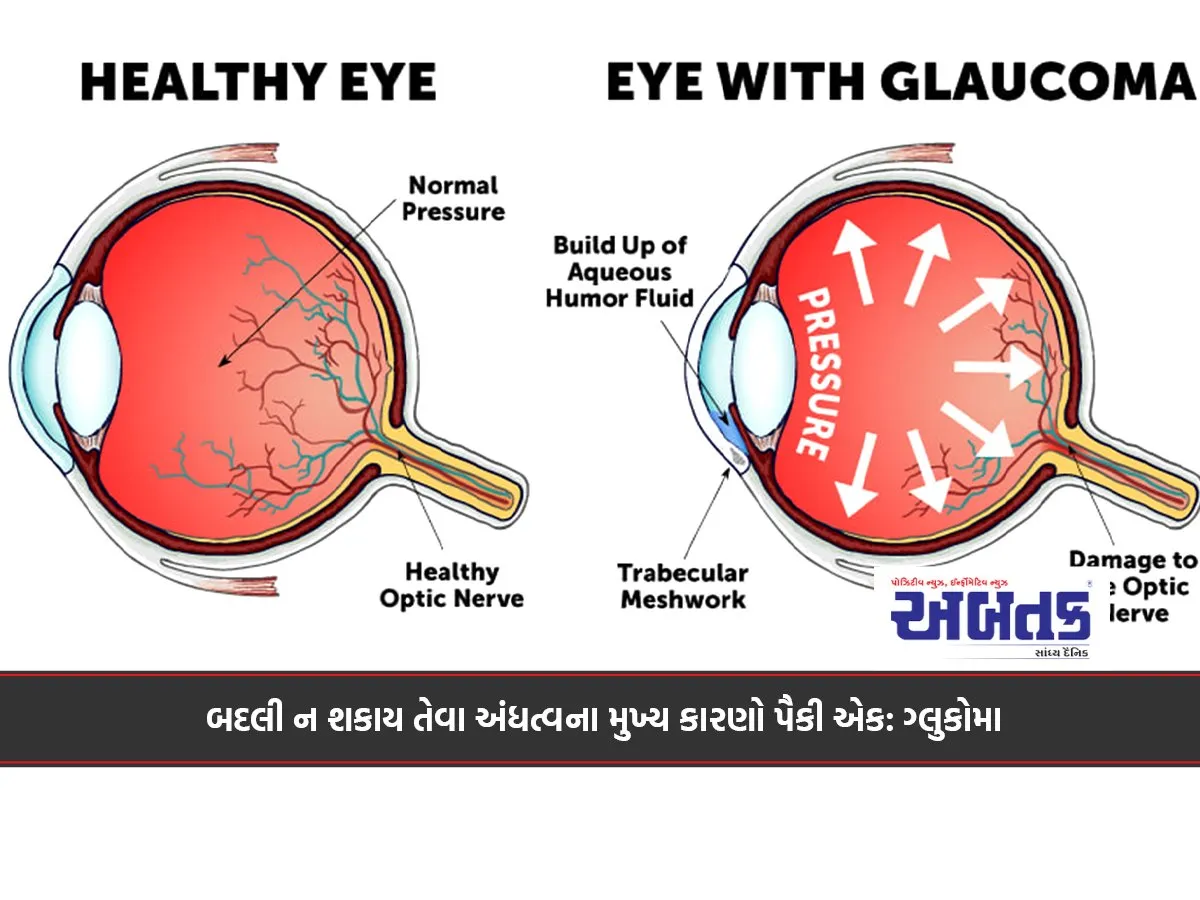 One of the leading causes of irreversible blindness: Glaucoma