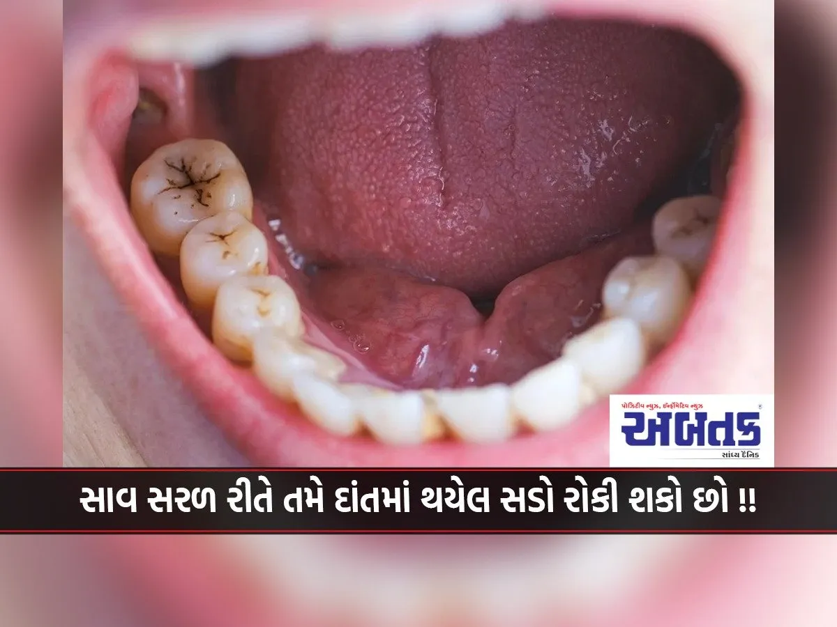 You Can Prevent Tooth Decay In A Very Simple Way!!